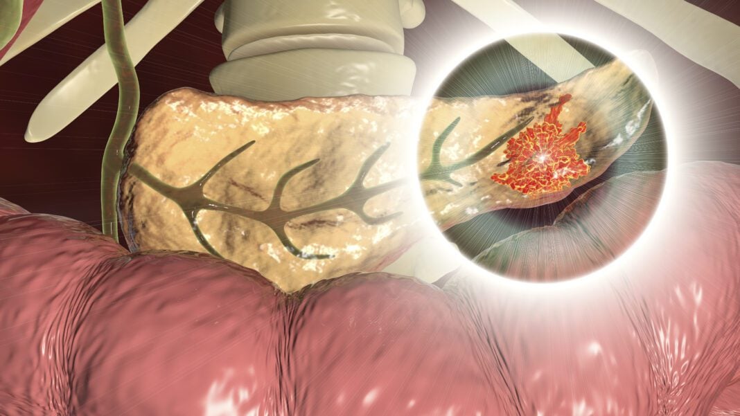Pancreatic cancer, malignant tumor of pancreas, 3D illustration, Getty Images