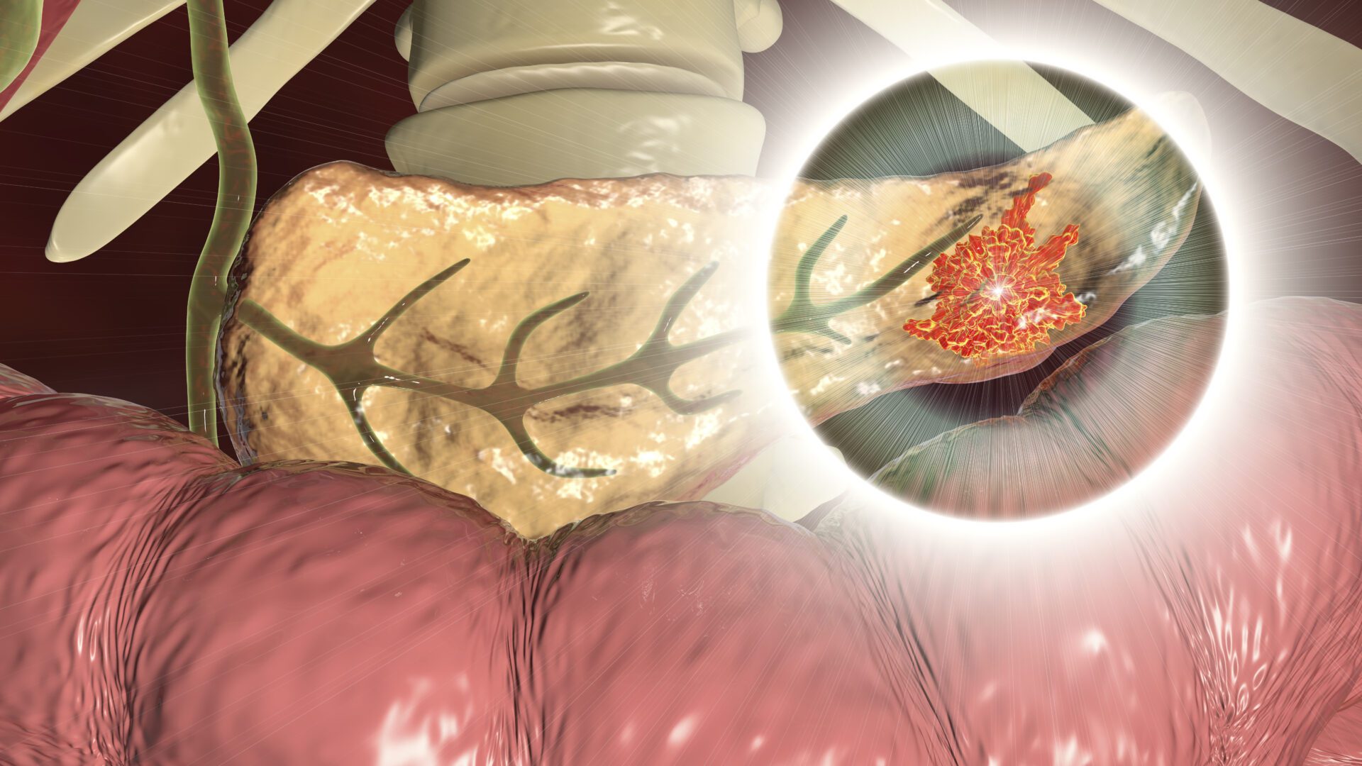 Pancreatic cancer, malignant tumor of pancreas, 3D illustration, Getty Images