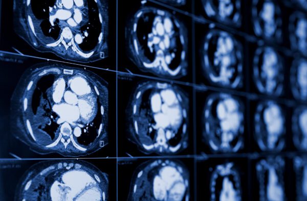 computed tomography of the chest. Medical background. monochrome photos