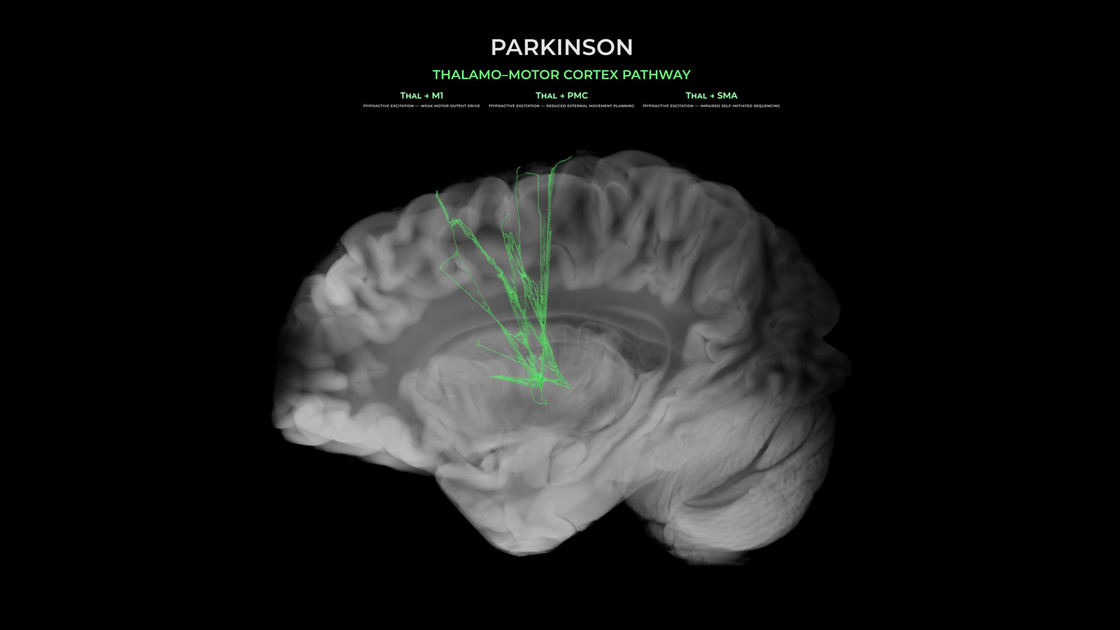 $9 million grant funds IU-led Parkinson’s disease research initiative 